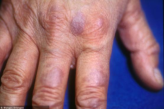 Gottron-Knoten bei Dermatomyositis