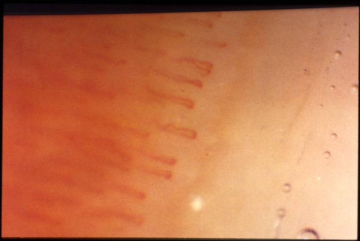 Kapillarmikroskopie des Nagelfalz: 
Lichtmikroskopische Untersuchung von Abnormalitten der Nagelfalzkapillaren mit einem Auflichtmikroskop zum Nachweis von strukturellen Gefwandvernderungen: Normalbefund