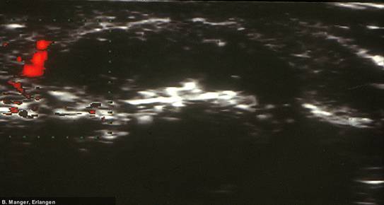 Calcinosis cutis (Doppler-Aufnahme) bei Dermatomyositis