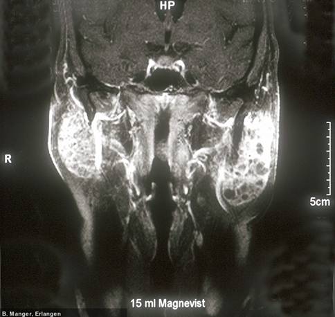 Chronische beidseitige Parotis-Schwellung bei Sjgren-Syndrom