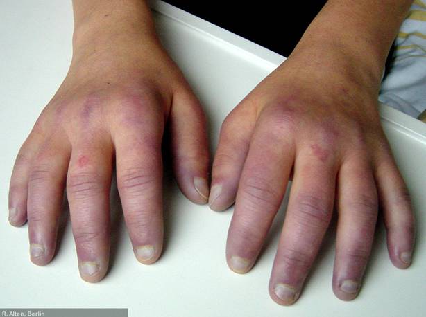 Raynaud-Syndrom