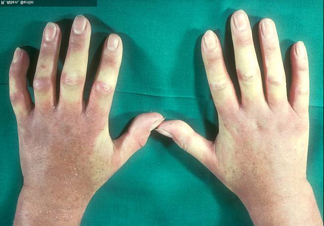 Raynaud-Syndrom