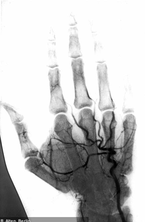 Raynaud-Syndrom