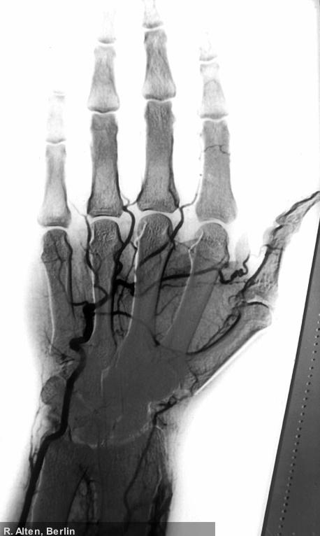 Raynaud-Syndrom