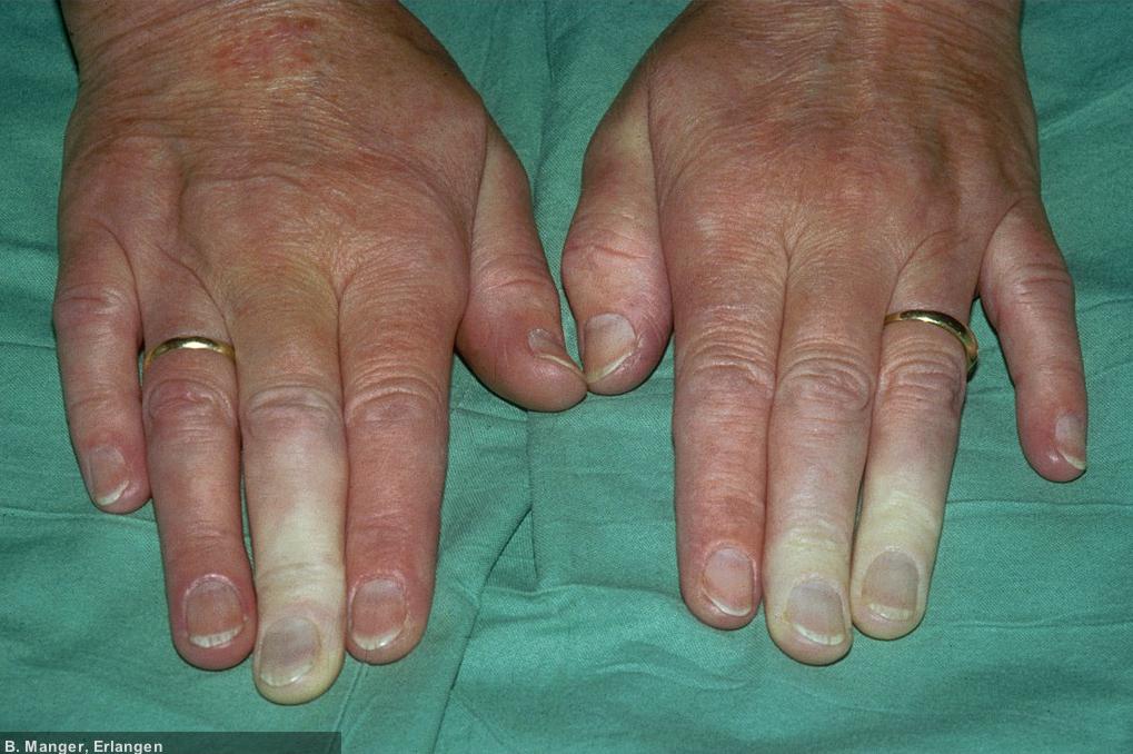 Raynaud-Syndrom