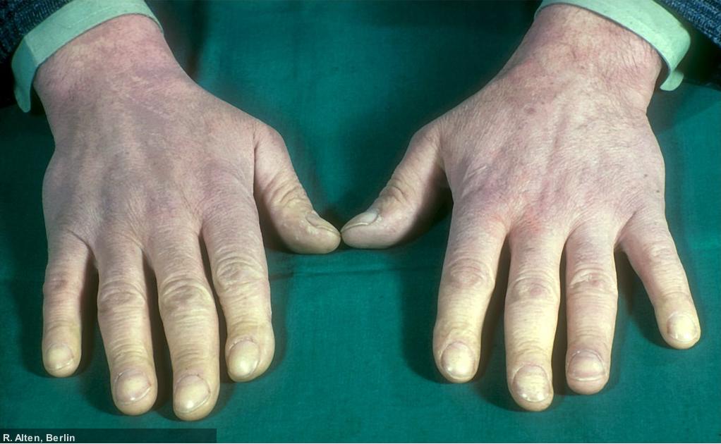 Raynaud-Syndrom