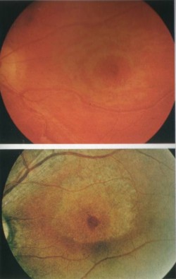 Nebenwirkungen von Chloroquin am Auge