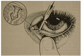 Punctum plugs